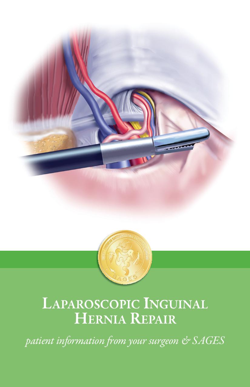 Laparoscopic Inguinal Hernia Repair Anatomy Anatomy S vrogue.co