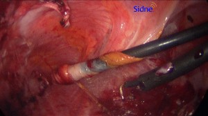 Thoracoscopic PSP Fig 3 pleurectomy