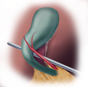 Safe Chole Figure 1A Critical view of safety anterior view