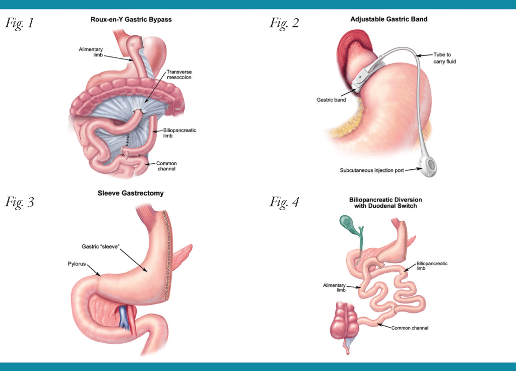 morbidobesity_page_3