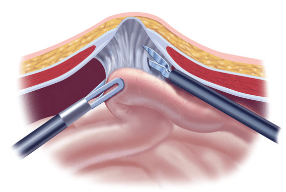 Laparoscopic Ventral Hernia Repair Information From Sages