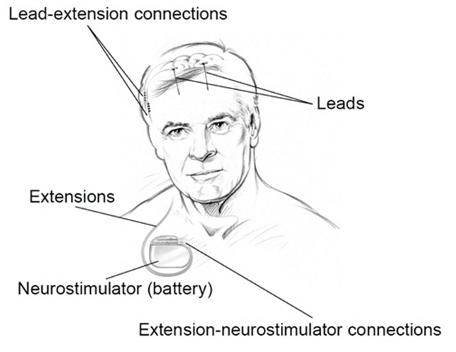 Medtronic DBS System for Epilepsy - A SAGES Technology and Value Assessment