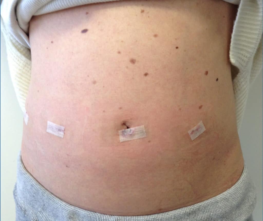 hernia photos before and after tummy tuck