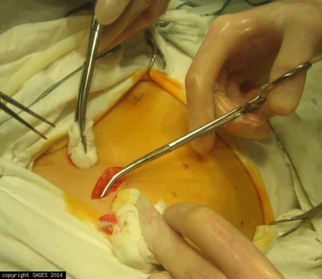 mini-invasive surgery of the biliary system