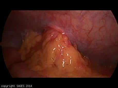 5 mm trocar site hernia